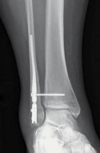 Open reduction of ankle fractures has been associated with high rates of deep wound sepsis, particularly in the elderly and diabetics, and in patients where the soft tissue envelope is swollen and
