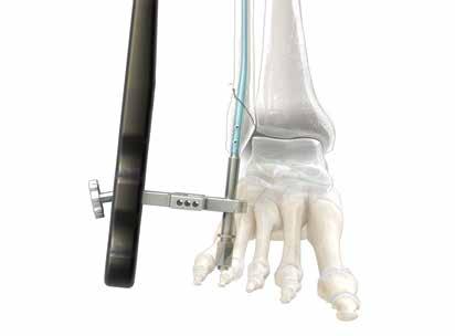 Acumed Fibula Rod System Surgical Technique 6 FRACTURE REDUCTION The distal fragment is now secured to the Fibula Rod (40-00XX-S), which in turn is securely attached to the targeting guide (assembly).