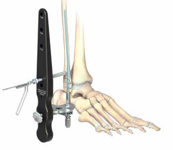 For example, Supination External Rotation Ankle fractures will typically involve gentle traction and internal rotation. Careful confirmation of adequate reduction using fluoroscopy is recommended.