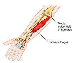 Palmaris Longus Absent in about 14% of population Absence does not affect grip strength Disadvantage: absence