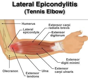 Tennis Elbow (Lateral epicondylitis) Repeated or violent extension of the wrist with forearm pronated (i.e. movements required during backhand strokes in lawn tennis), leads to tenderness over lateral epicondyle of humerus.