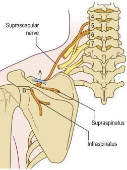 Suprascapular Nerve Entrapment Entrapment may occur as it passes through suprascapular notch or in spinoglenoid notch.