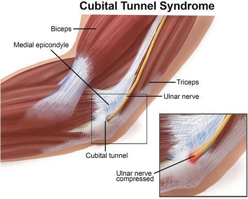 Ulnar Nerve Injury at Cubital Tunnel (Cubital Tunnel Syndrome) Cubital Tunnel Formed by tendinous arch connecting 2 heads of flexor carpi ulnaris