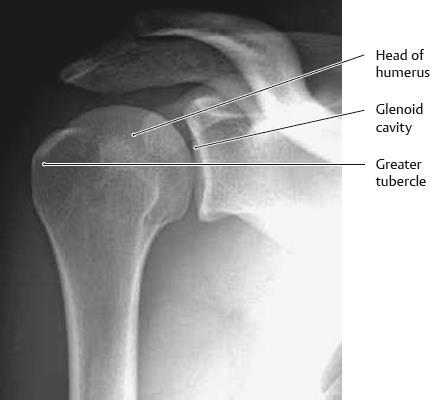 Glenohumeral Joint Dislocation Most commonly dislocated major joint in body.