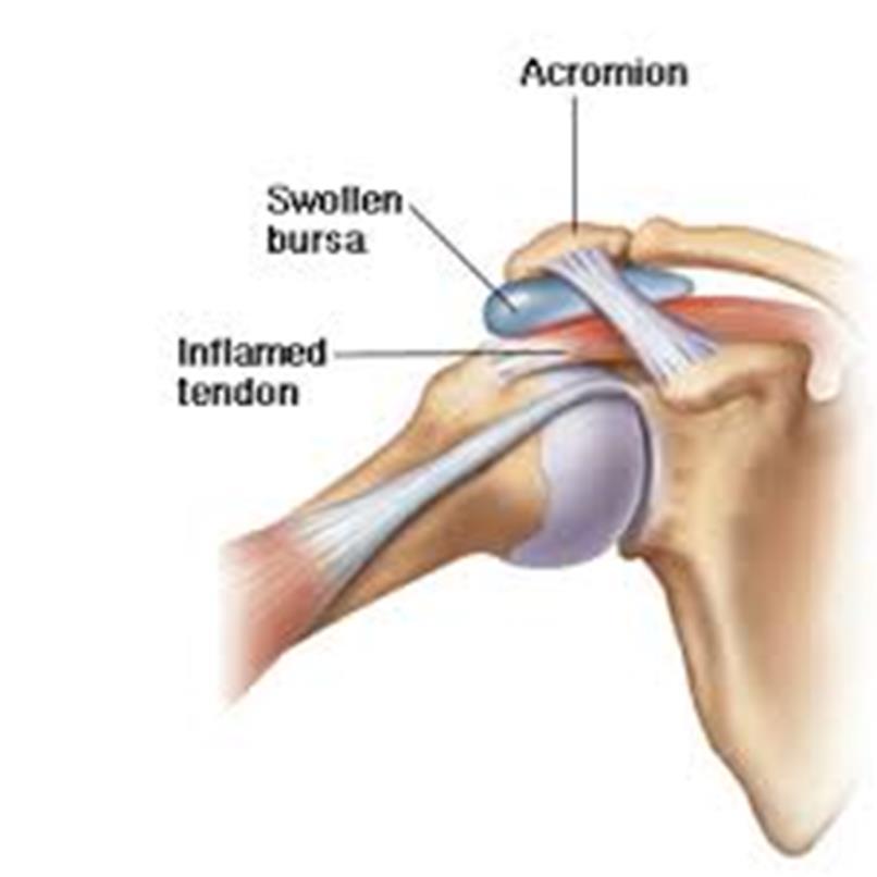 Subacromial Bursitis Shoulder joint in abducted position = Pain Subacromial bursa is located inferior to acromion, above supraspinatus tendon.