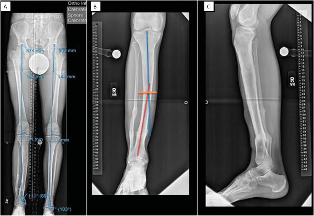 J Orthop Trauma Volume 31, Number 6 Supplement, June 2017 Lengthening Nail Reconstruction FIGURE 1. Tibial malunion case, preoperative. A, Erect leg x-ray showing LLD of 25 mm and valgus alignment.