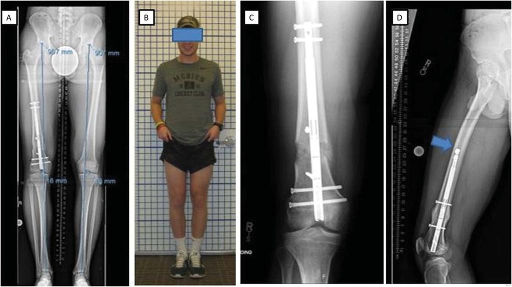 Rozbruch J Orthop Trauma Volume 31, Number 6 Supplement, June 2017 FIGURE 6. After consolidation. A, Erect leg x-ray showing correction of valgus and LLD. B, Clinical photograph.