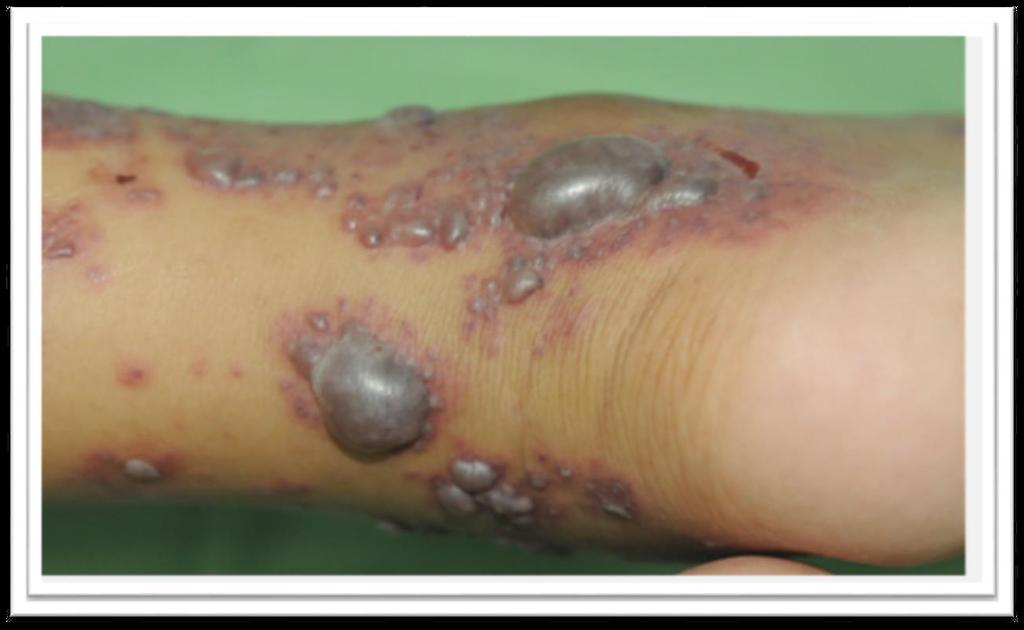 Morphology of Rash With continued treatment