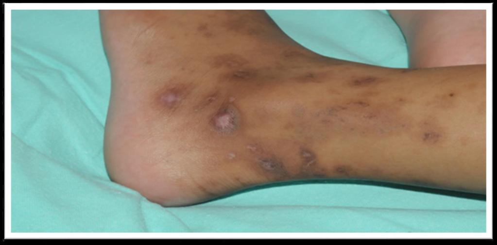 At 6 week follow up, the lesions showed