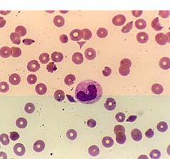 Laboratory data WBC: 18,000 Hct 16% Platelets 25K Creatinine: 4.
