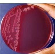 E. coli 0157:H7 from improperly cooked meats There is often a prodrome of gastroenteritis or URI, then sudden severe illness with lethargy and pallor Clinical features: microangiopathic anemia, acute