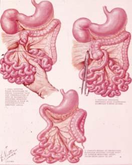 Facts of life Volvulus Midgut volvulus with malrotation Gut malrotation is a embryological failure of rotation and bowel fixation that occurs in 1/500 births.