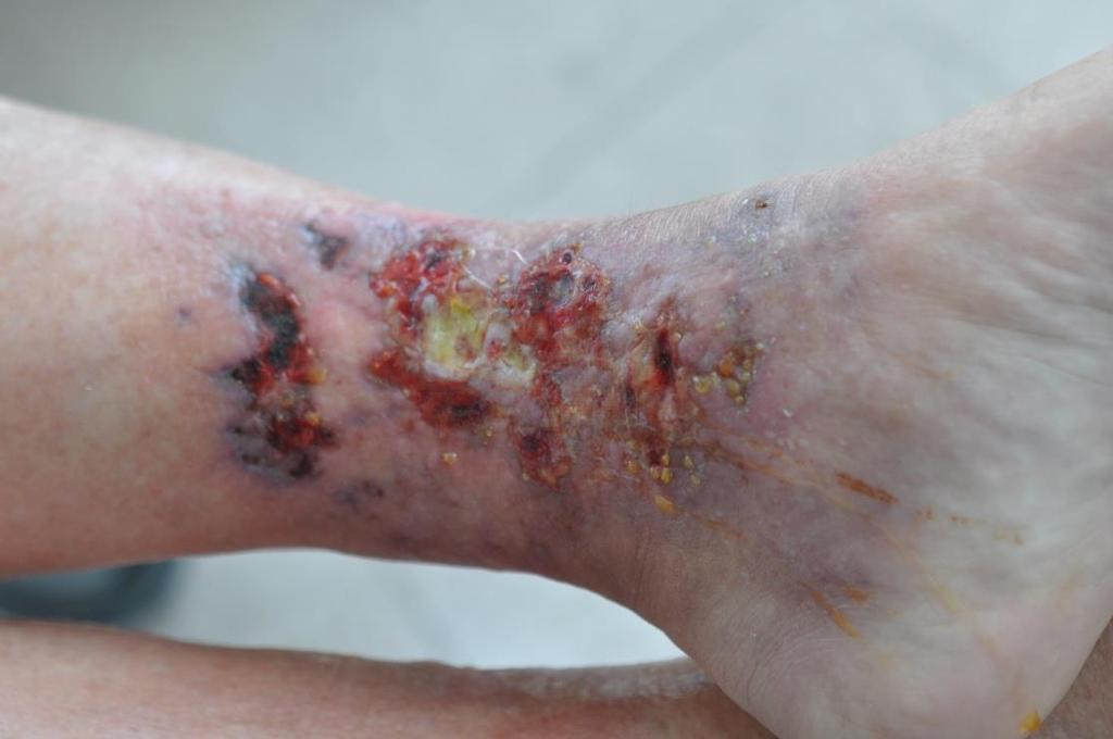 Polyarteritis Nodosa Skin lesions are seen in 60% of