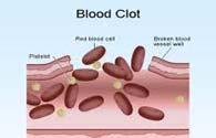 RBC and Platelets Trapped in Fibrin Clot