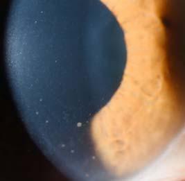 Hypertensive anterior uveitis Fuchs Uveitis Syndrom unilateral (15% bilateral), diffuse small stellate KP, minimal AC