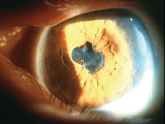 Anterior Uveitis: Clinical Issues Diagnostics: yes