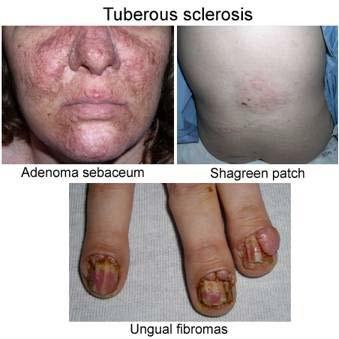 Autosomal Dominant Disease Tuberous Sclerosis: Tuberous sclerosis or tuberous sclerosis complex (TSC) is a rare, multi-system genetic disease that causes benign tumours to grow in the brain and on