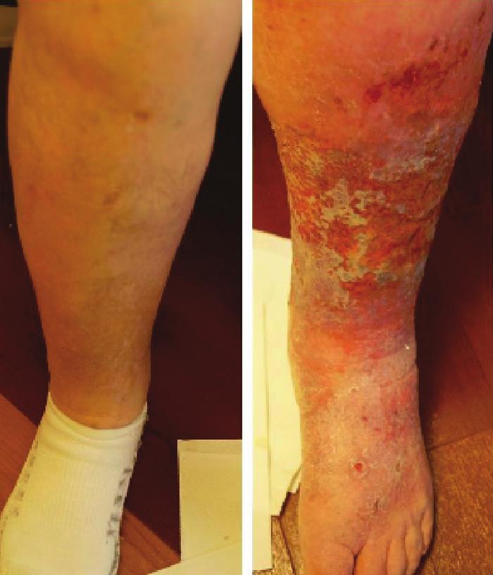 WHAT WOULD YOU DO? Chronic Swelling, Pain, and Ulceration in the Left Lower Extremity MODERATOR: BROOKE SPENCER, MD, FSIR PANEL: LAWRENCE RUSTY HOFMANN, MD; MARK J.