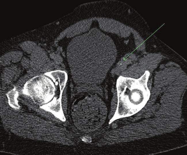 CHALLENGING CASES if there are pelvic or abdominal wall superficial varicosities on examination, then I would perform CT venography (CTV) to evaluate the central (including the inferior vena cava