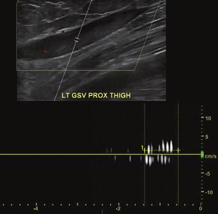 The pelvic CTV assesses for venous outflow obstruction, including left iliac vein and/or IVC scarring as well as May-Thurner compression of the left common iliac vein (CIV).