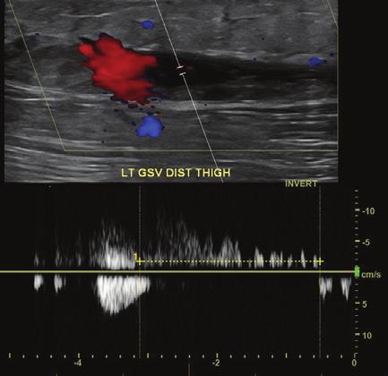 Left lower extremity ultrasound for and superficial reflux study demonstrate changes of chronic in the left calf, the popliteal and femoral veins, and CFV. The vessels are patent and recanalized.