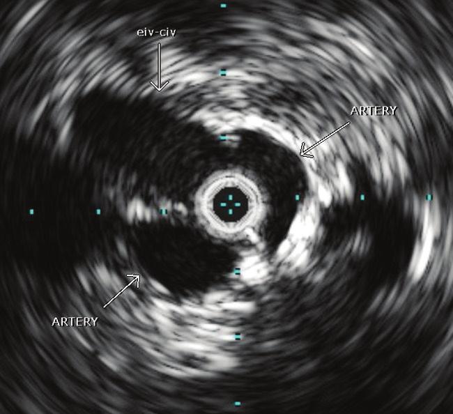 Figure 9. IVUS showing a web in the CFV/EIV junction. Figure 10. IVUS showing a misshapen EIV. Figure 11.