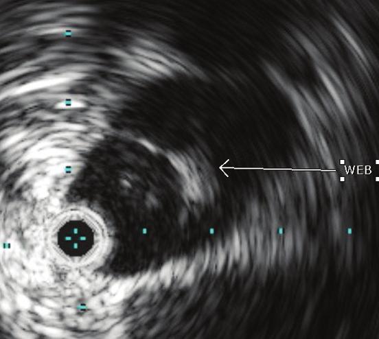 stenoses were questionable and/or flow did not improve after angioplasty, I would use IVUS to identify stenotic areas and/or regions of significant webbing to target with additional angioplasty or