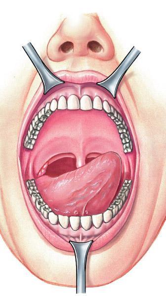 ORAL CAVITY buccal cavity - lined with mucosa- (stratified squamous) Hard and soft palates - form roof