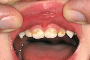 Early Childhood Caries Caries in early childhood result from several factors, some Acquisition of bacteria Streptococcus Mutans causing rapid demineralization of