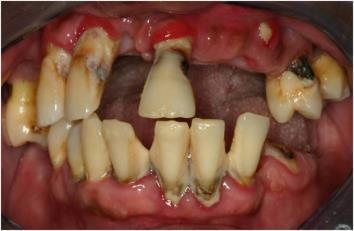 Periodontal Disease Mainly the result of infections and inflammation of the gums and bone that surround and support the teeth Early stage known as Gingivitis Gums are