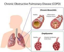 COPD = Chronic