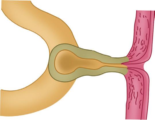 Umbilical sinus: Persistence of the yolk stalk close to the umbilicus results in the formation of the umbilical