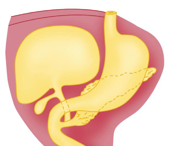 112 Chapter 11 Ventral mesentery Peritoneal cavity Hepatic diverticulum Yolk stalk Dorsal Mesentry