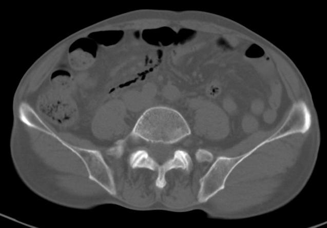 Abdominal CT Air within the mesentery (red arrows) Suggestive of perforation of the 3 rd