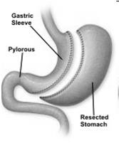 Sleeve Gastrectomy Roux