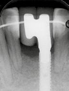 4, First x-ray follow-up: 4 months after implant loading (9 months after grafting and Fig.