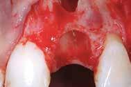 1 Flap formation showing the extraction socket. The large labial fenestration defect is clearly visible. Fig.
