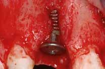 Early implant placement with filling of a peri-implant defect, combining an autogenous bone graft with Geistlich io-oss to correct substantial tissue loss (front region)