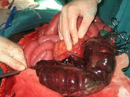 Small bowel volvulus