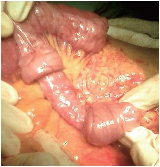 Intussusception 