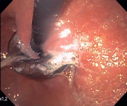 erodes into stomach Presents with > port infection