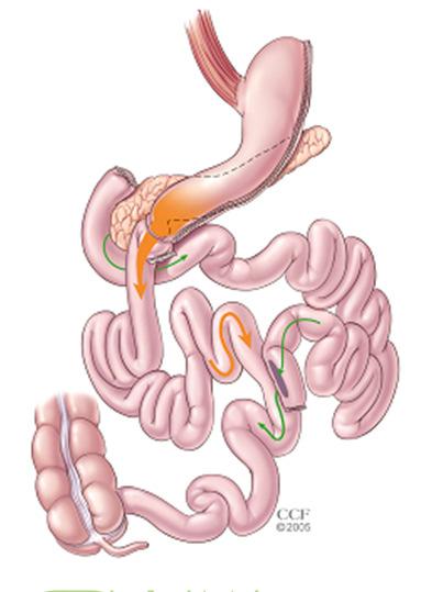 Less common bariatric operations Duodenal