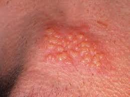 - red bumps turn into watery blisters that ooze or bleed After