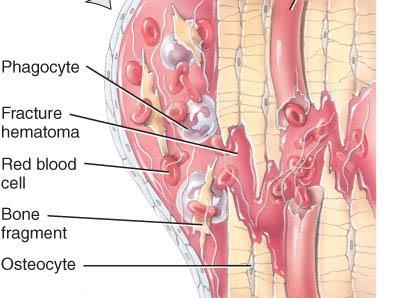 REPAIR OF BONE FRACTURE Step 1: Formation of fracture haematoma damaged blood vessels produce clot in 6-8 hours, bone cells die inflammation brings