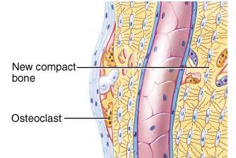 remodeling compact bone replaces the spongy bone in the bony callus surface is