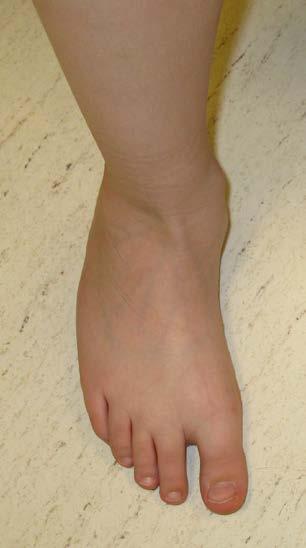Skewfoot Adducted forefoot and valgus hindfoot