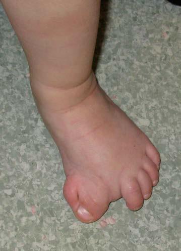 Hallux varus Medial border of the foot is straight but the great toe is medially deviated Abnormal pull of the Abductor Hallucis Often associated