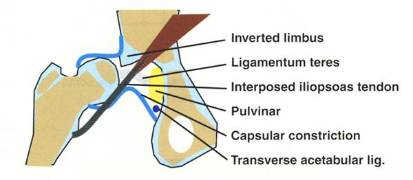 DEVELOPMENTAL DISLOCATION OF THE HIP [DDH] Older terminology was Congenital dislocation of the hip. DDH means developmental dysplasia of the hip.