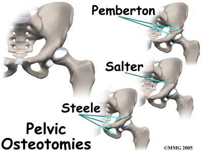 PELVIC OSTEOTOMY TYPES I Redirectional osteotomy: Increase anterior lateral coverage of the femoral head by redirecting roof of the acetabulum.