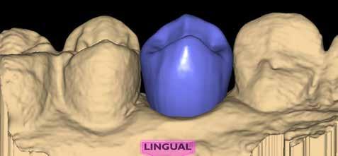 11 Use Rubber Tooth to re-contour the axial walls of your proposal. Examine your axial contours from a profile view, and ensure they are similar in shape to the adjacent teeth.